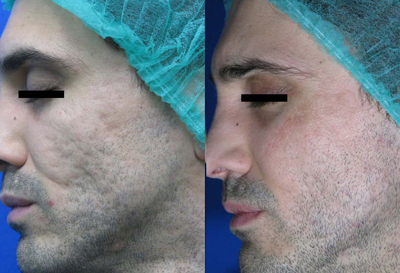 coolpeel-before-after-3
