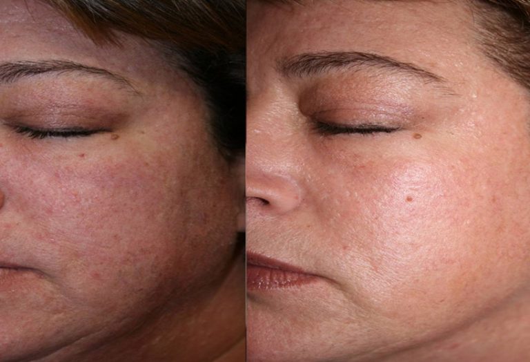 coolpeel-before-after-5