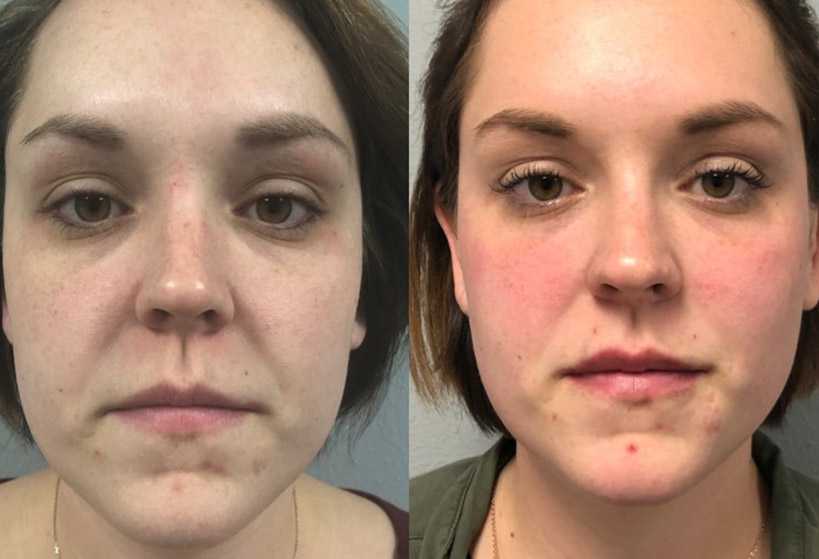 coolpeel-before-after-7