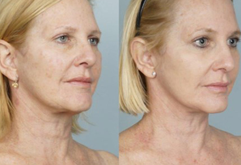 coolpeel-before-after-9