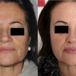 Before and after Coolpeel procedure- Beauty Refined Plastic Surgery - Palm Desert, Palm Springs, and surrounding areas. Before and after Coolpeel procedure- Beauty Refined Plastic Surgery - Palm Desert, Palm Springs, and surrounding areas.