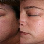 Palm Desert Plastic Surgery- coolpeel-before-after-5 Palm Desert Plastic Surgery- coolpeel-before-after-5