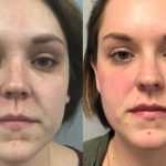 Dr. Tantawi Beauty Refined Plastic Surgery - Palm Desert, Palm Springs, and surrounding areas-coolpeel-before-after-7 Dr. Tantawi Beauty Refined Plastic Surgery - Palm Desert, Palm Springs, and surrounding areas-coolpeel-before-after-7