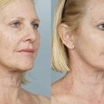 Palm-Desert-Plastic-Surgery-coolpeel-before-after-9 Palm-Desert-Plastic-Surgery-coolpeel-before-after-9